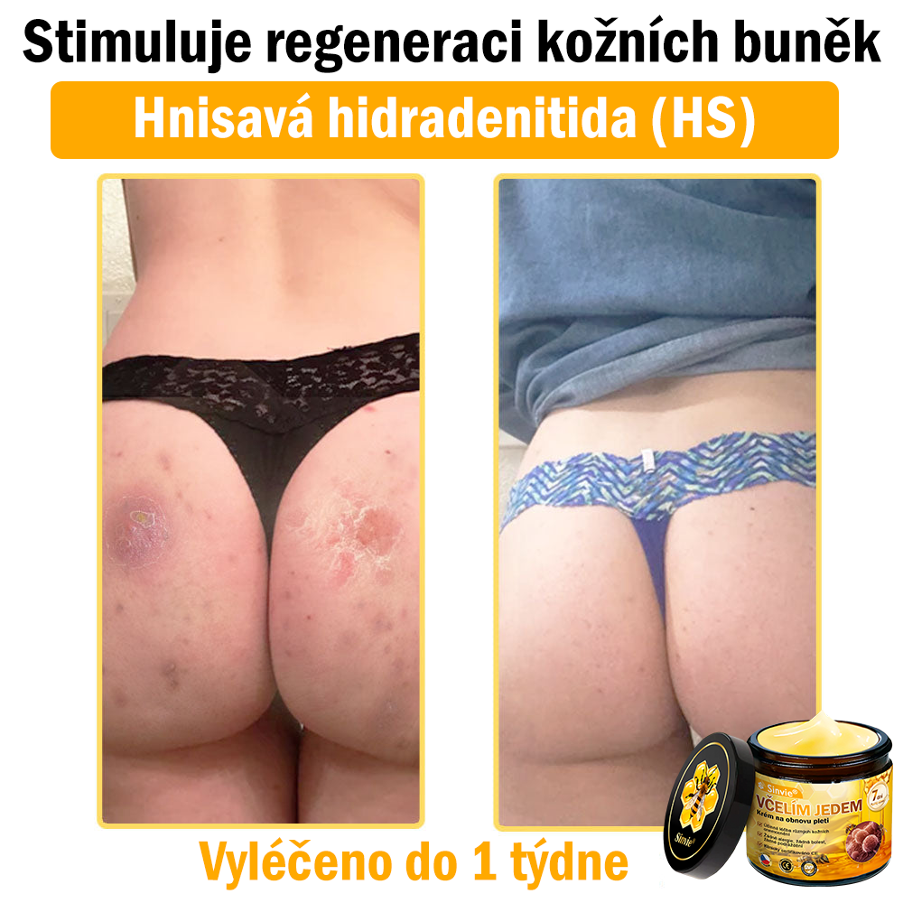 Sinvie® Krém na obnovu pleti s včelím jedem | 50 ml | Doporučeno Českou dermatovenerologickou společností