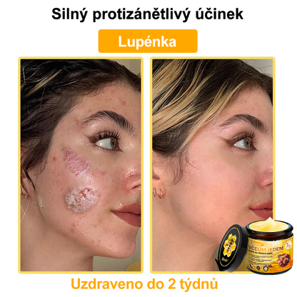 Sinvie® Krém na obnovu pleti s včelím jedem | 50 ml | Doporučeno Českou dermatovenerologickou společností