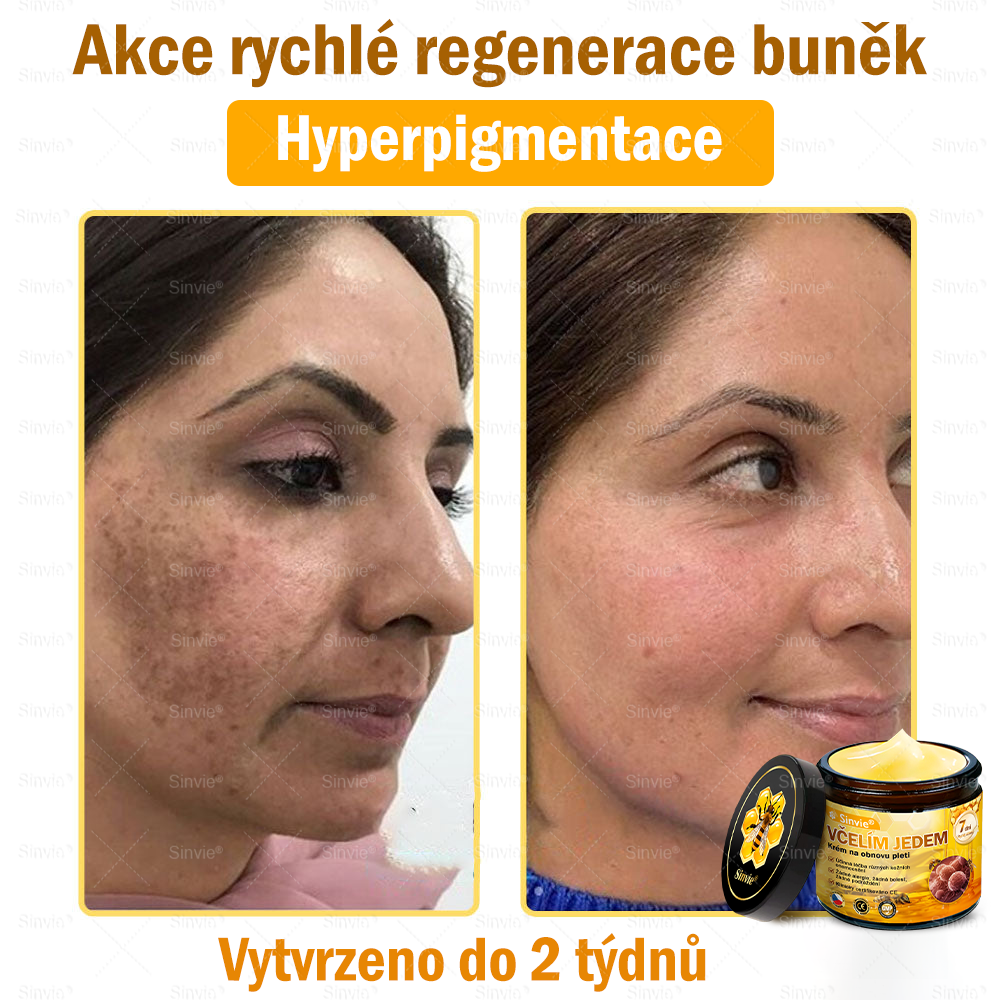 Sinvie® Krém na obnovu pleti s včelím jedem | 50 ml | Doporučeno Českou dermatovenerologickou společností